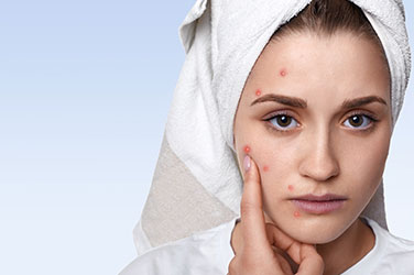 Closeup of facial skin with acne, showcasing effective acne treatment options for weight loss.
